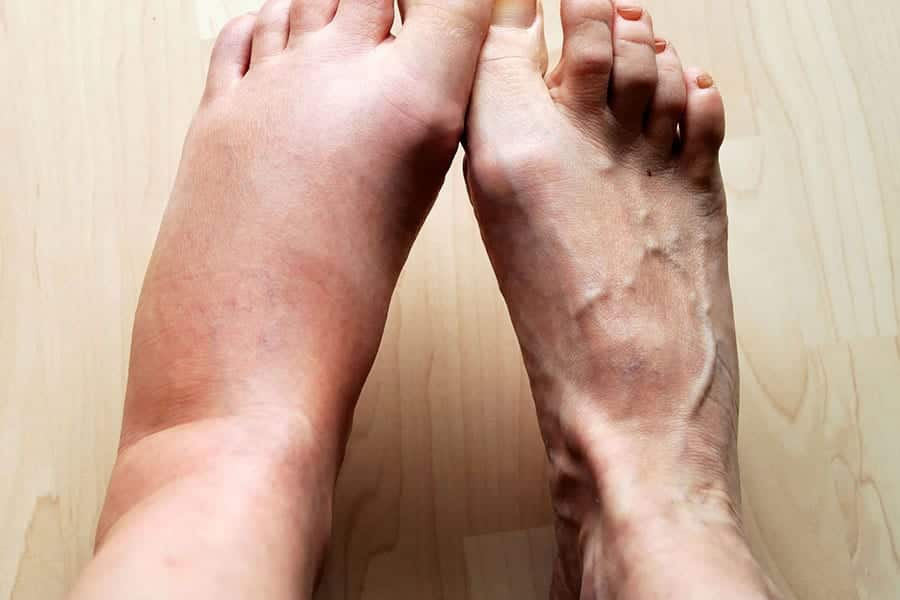 drenagem linfática em bh